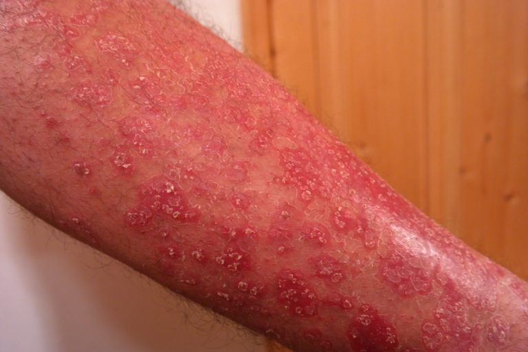 El Impacto Social Y Emocional De La Psoriasis